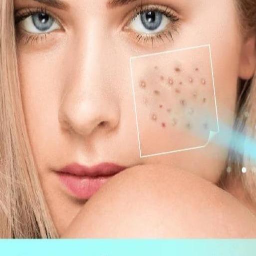 Face Skin Care Tools MEDZDERM™ Blue Light Acne & Skin Spot Remover - DiyosWorld