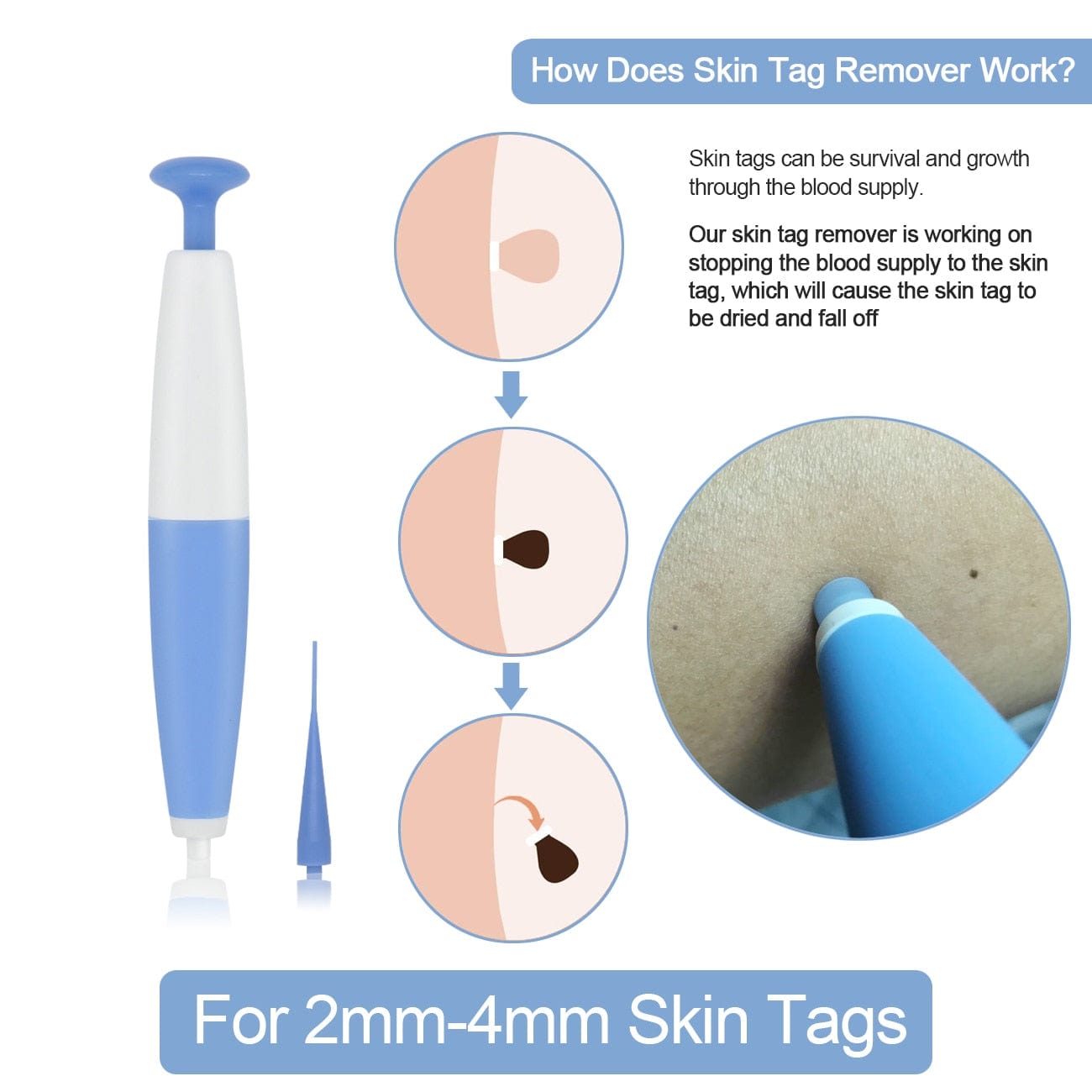Facial Care Tool DIYOS™ Skin Tag Remover - DiyosWorld